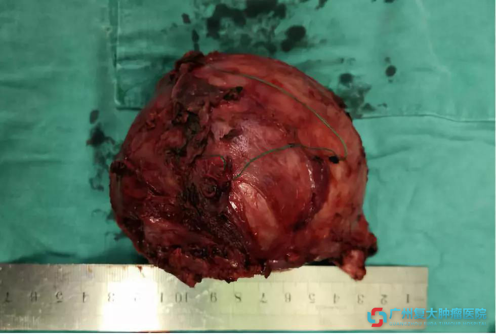 这么大的前列腺肿瘤你见过?这台手术让人震惊