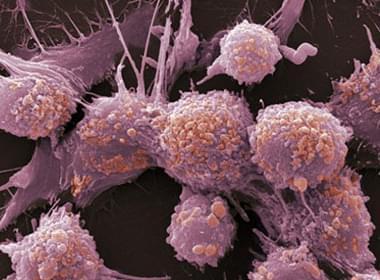 肿瘤治疗中阻止肿瘤细胞蔓延是关键
