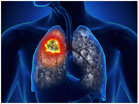 肺肿瘤晚期化疗有用吗?